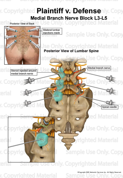 illustration-nerve-block-injection-l3-l5-001