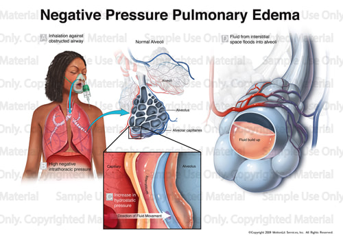 illustration-pulmonary-edema-001