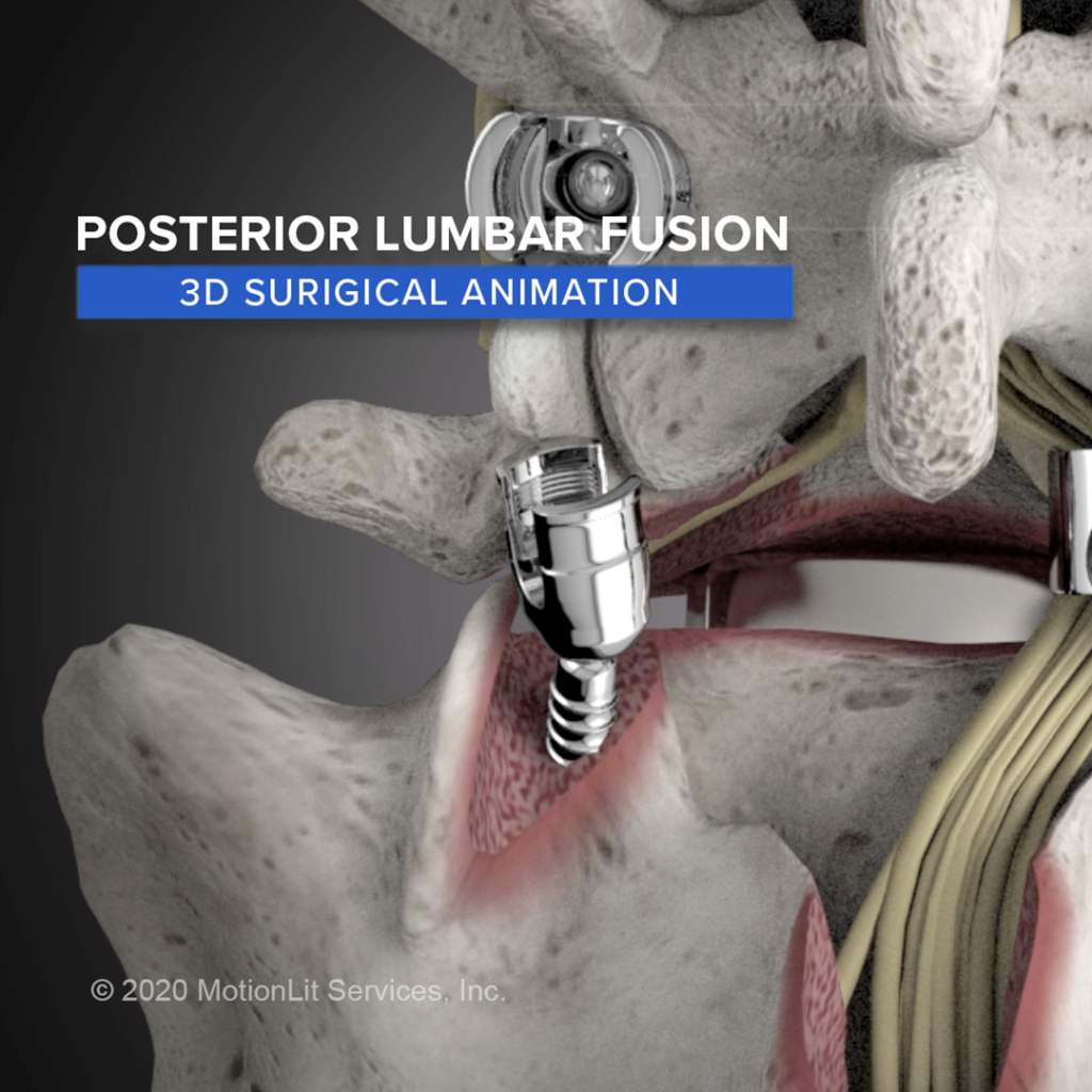 Posterior Lumbar Fusion - MotionLit