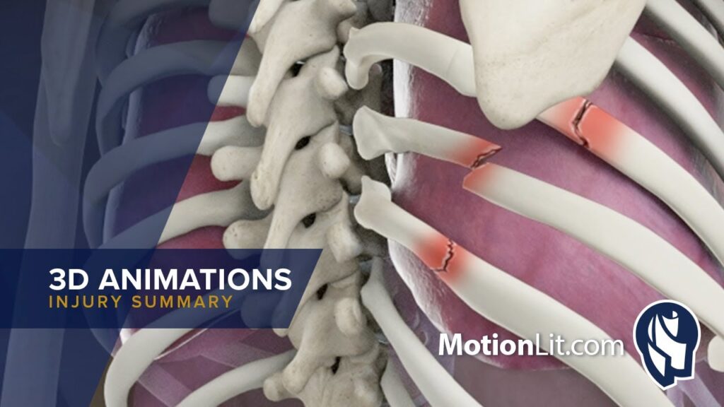 Animation Exhibits Complex Radius & Ulna ORIF Procedure - MotionLit
