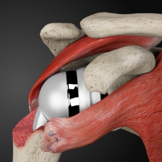 Calcification of Ulnar Collateral Ligament - MotionLit