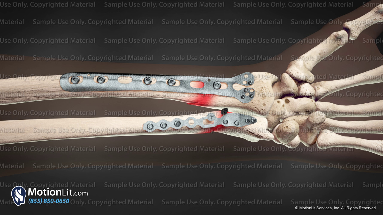 L Radius & Ulna ORIF MotionLit