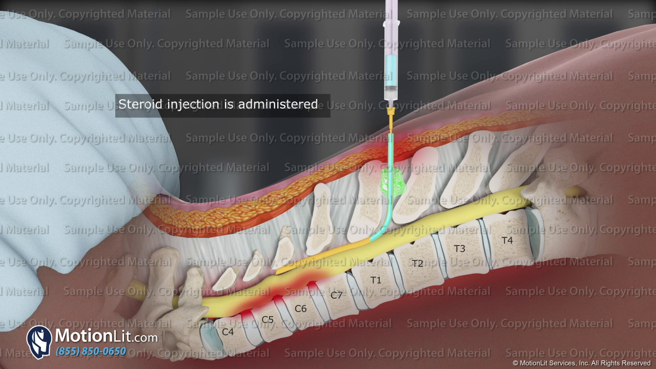 epidural-steroid-injection-c5-c6-motionlit