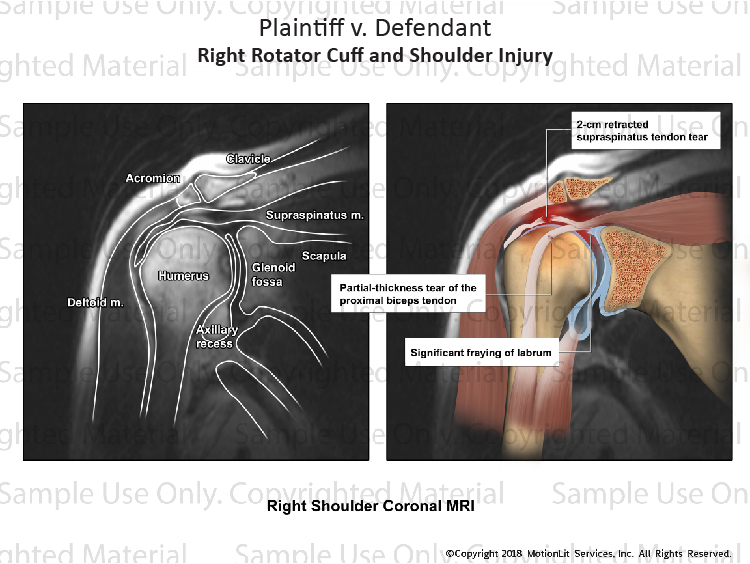 Right Rotator Cuff Tear - MotionLit