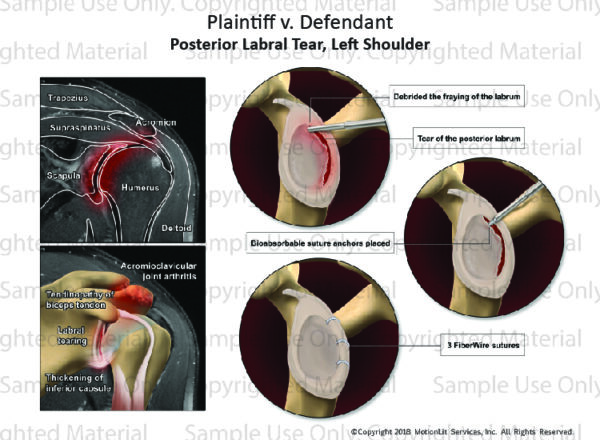 Posterior Labral Tear Injury - MotionLit