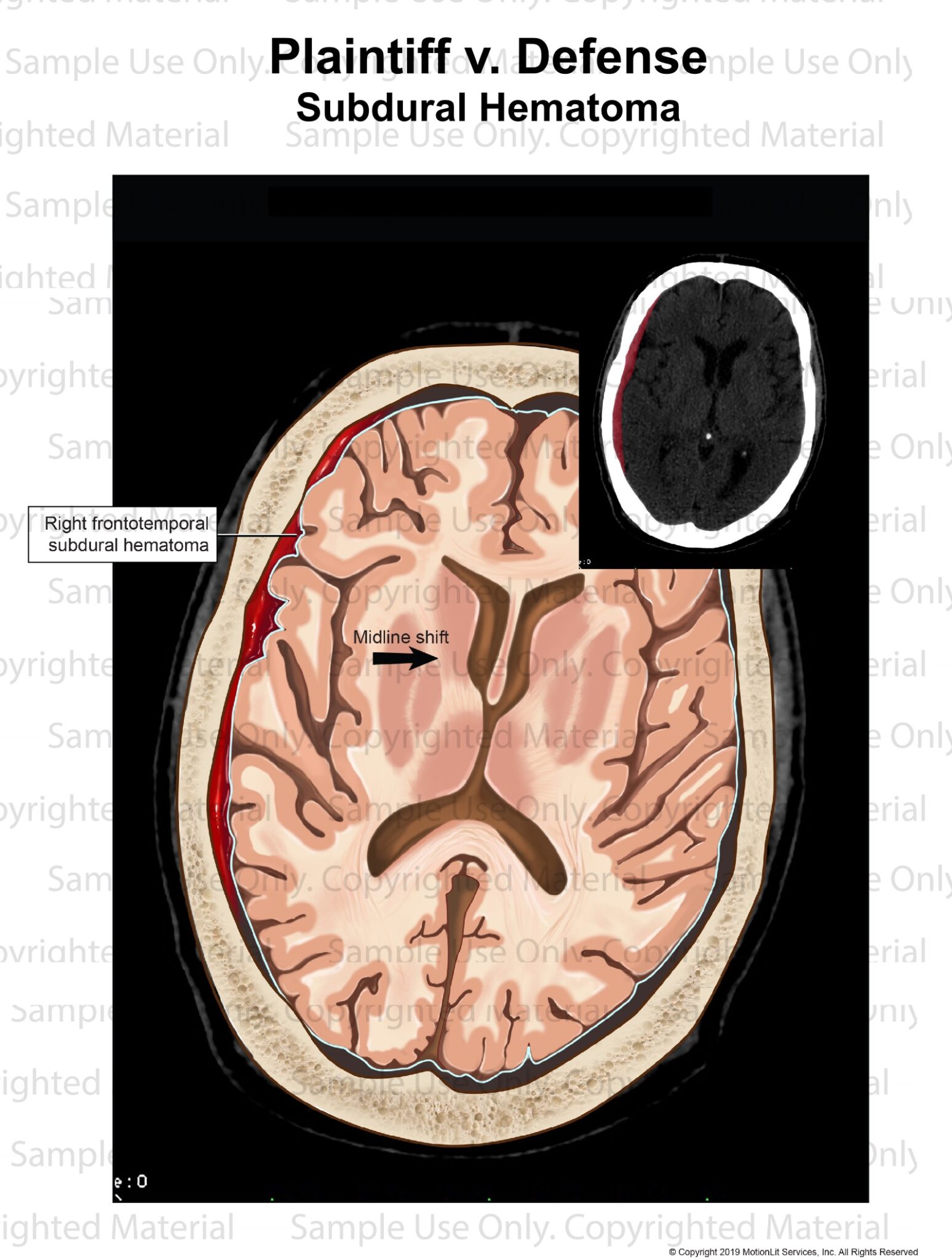 Subdural Hematoma CT interp 1 - MotionLit