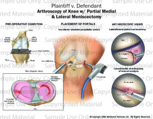 Arthroscopy of Knee: Partial Medial Lateral Meniscectomy - MotionLit