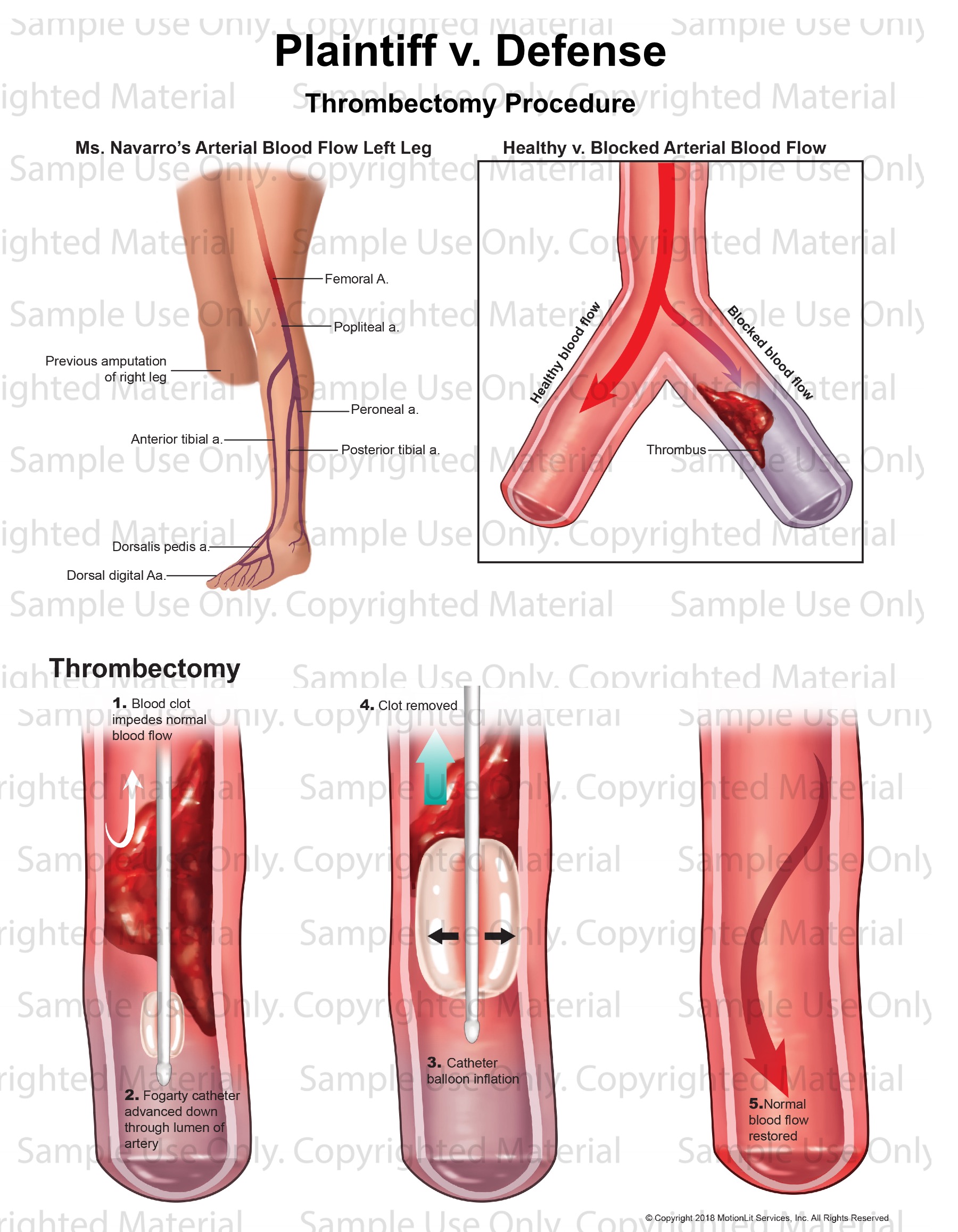 thrombectomy-procedure-motionlit