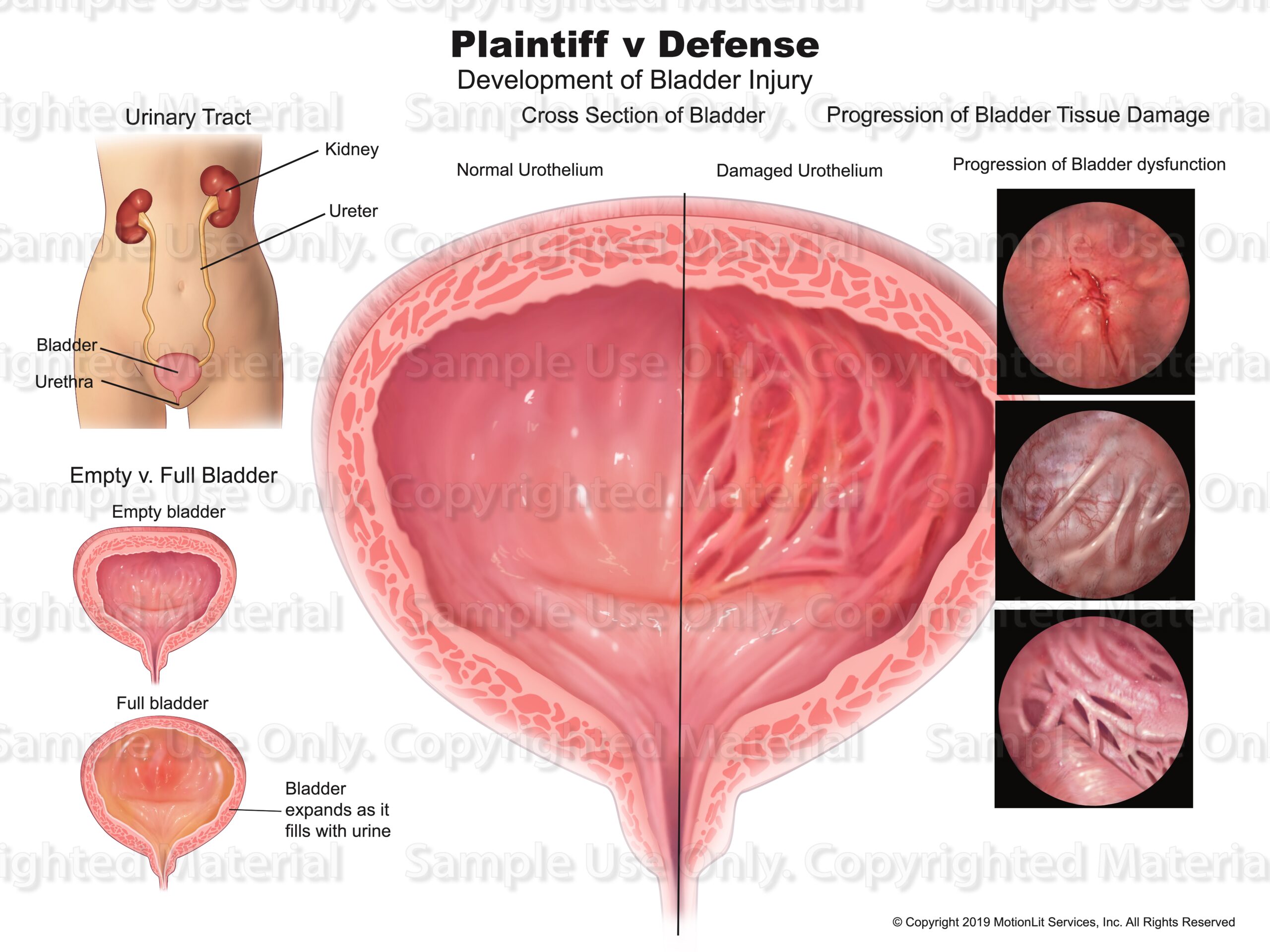 bladder-damage-motionlit