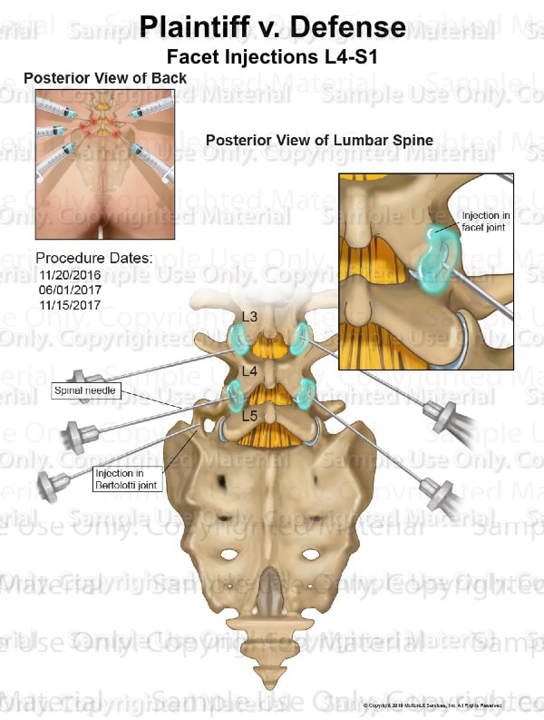 Facet Joint Injections L4S1 MotionLit