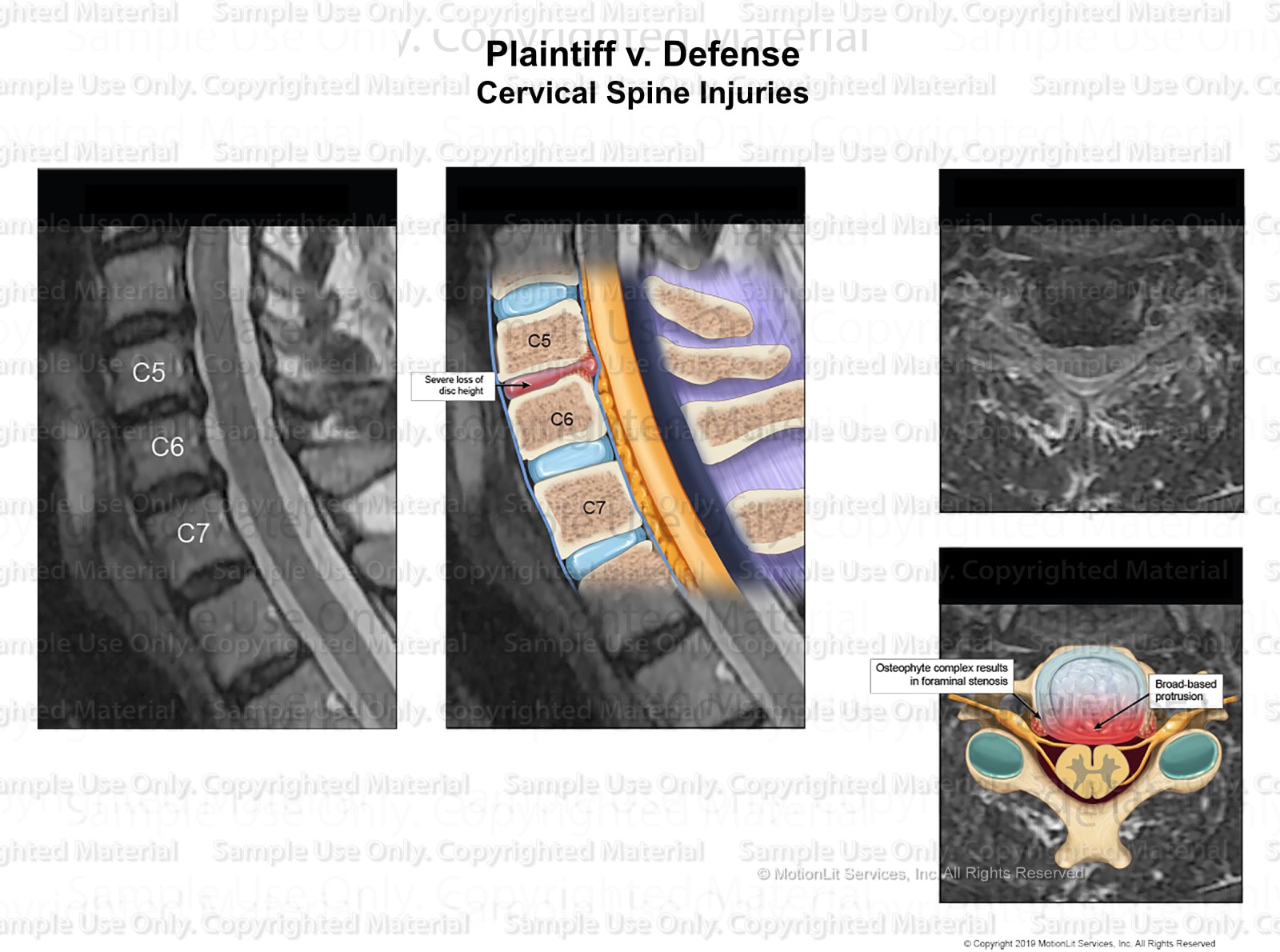 Injury Cervical C5-C6 - MotionLit