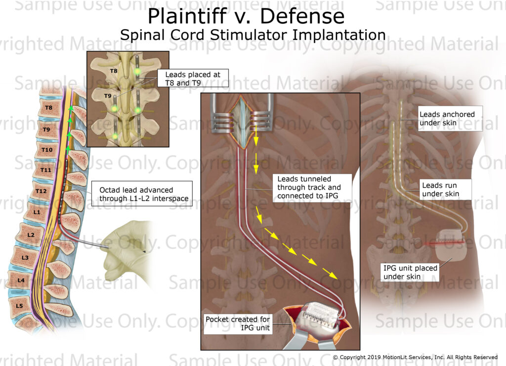 Spinal Cord Stimulator MotionLit