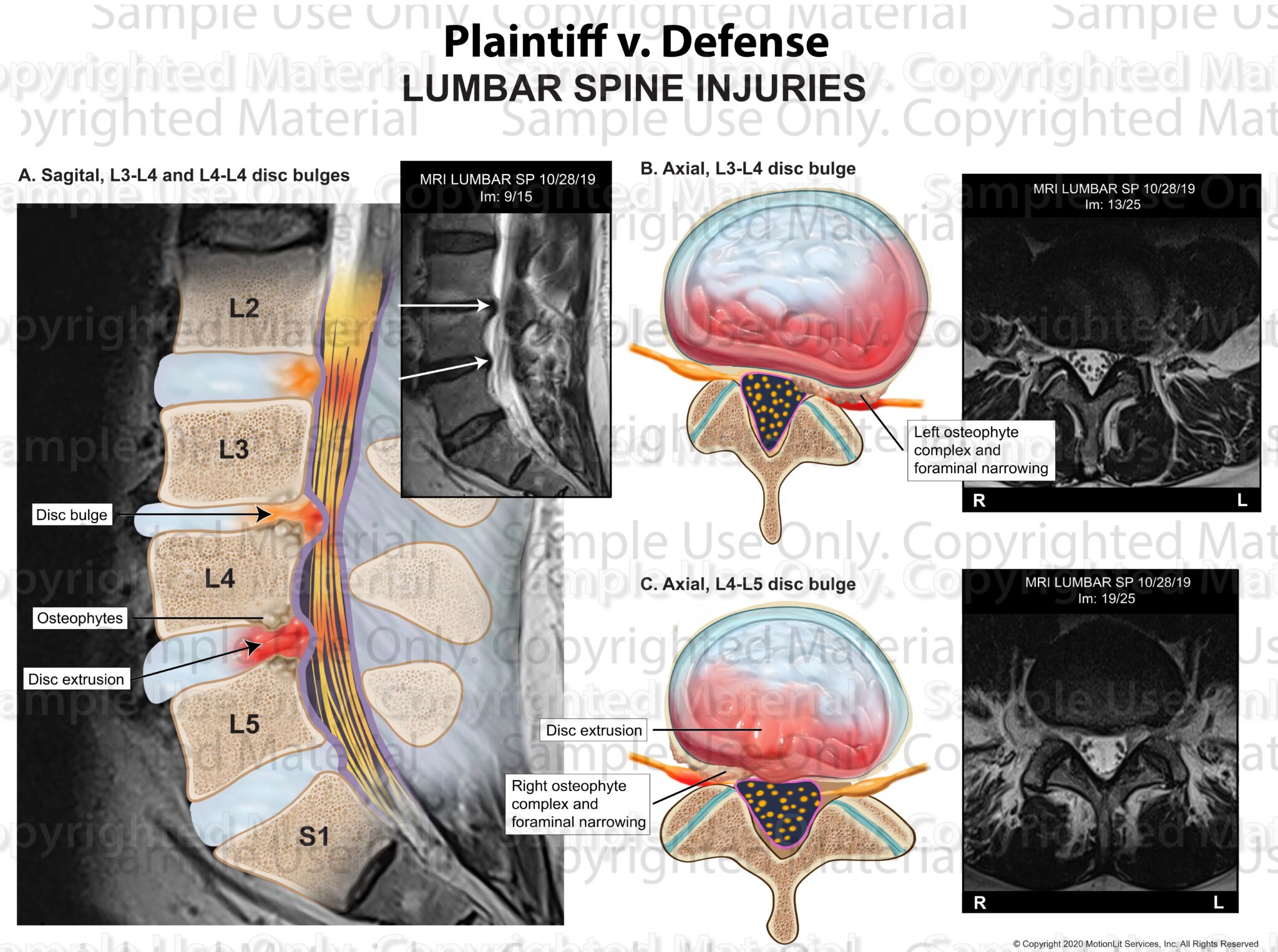 Disc Bulges / Stenosis L3-4 & L4-5 - MotionLit