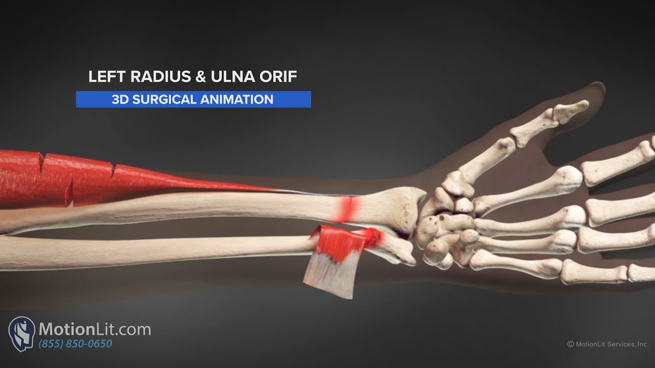 Animation Exhibits Complex Radius & Ulna ORIF Procedure MotionLit