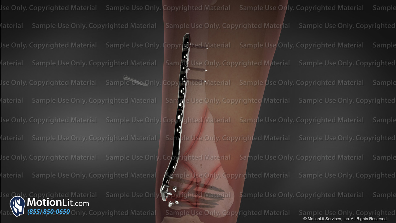 Distal Femoral Fracture ORIF - MotionLit